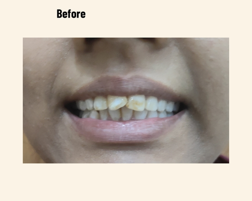 Best Dentist Noida Treatment for Dental Patient Case Number 3