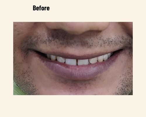 Best Dentist Noida Treatment for Dental Patient Case Number 5