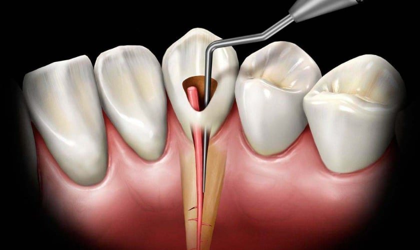 Root Canal Treatment (RCT) in Noida